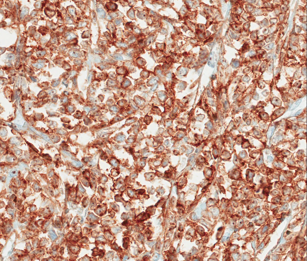 Mediastinal Mass CD7 40x
